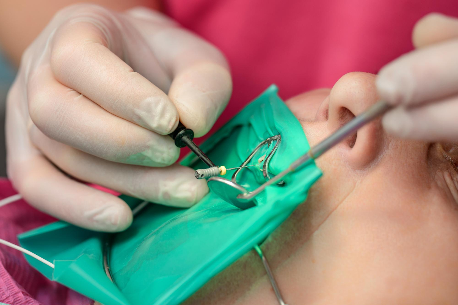 root canal