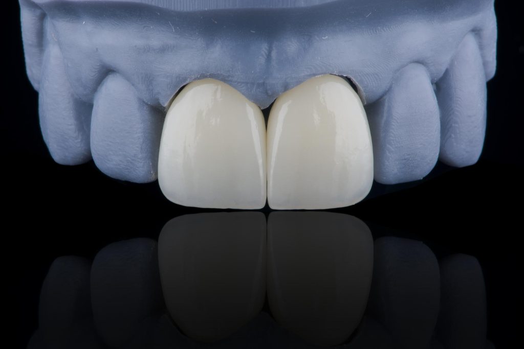 dental crowns